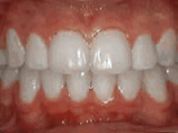 crowding of the teeth after crowding of the teeth after