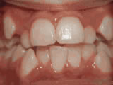 crowding of the teeth before crowding of the teeth before