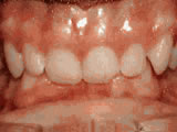 deep overbite before deep overbite before