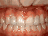 missing lateral incisors after missing lateral incisors after