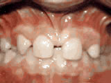 missing lateral incisors before missing lateral incisors before