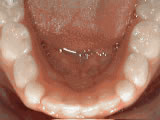 non braces treatment after non braces treatment after