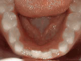 non braces treatment before non braces treatment before