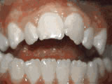 open bite before open bite before