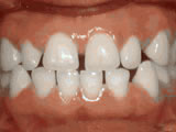 spacing of teeth before spacing of teeth before