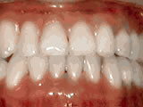 underbite after underbite after