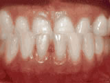 underbite before underbite before